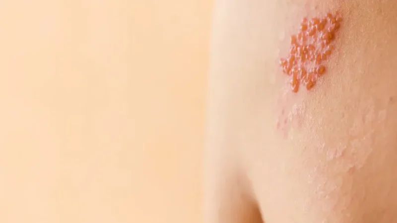 herpes-halodoc